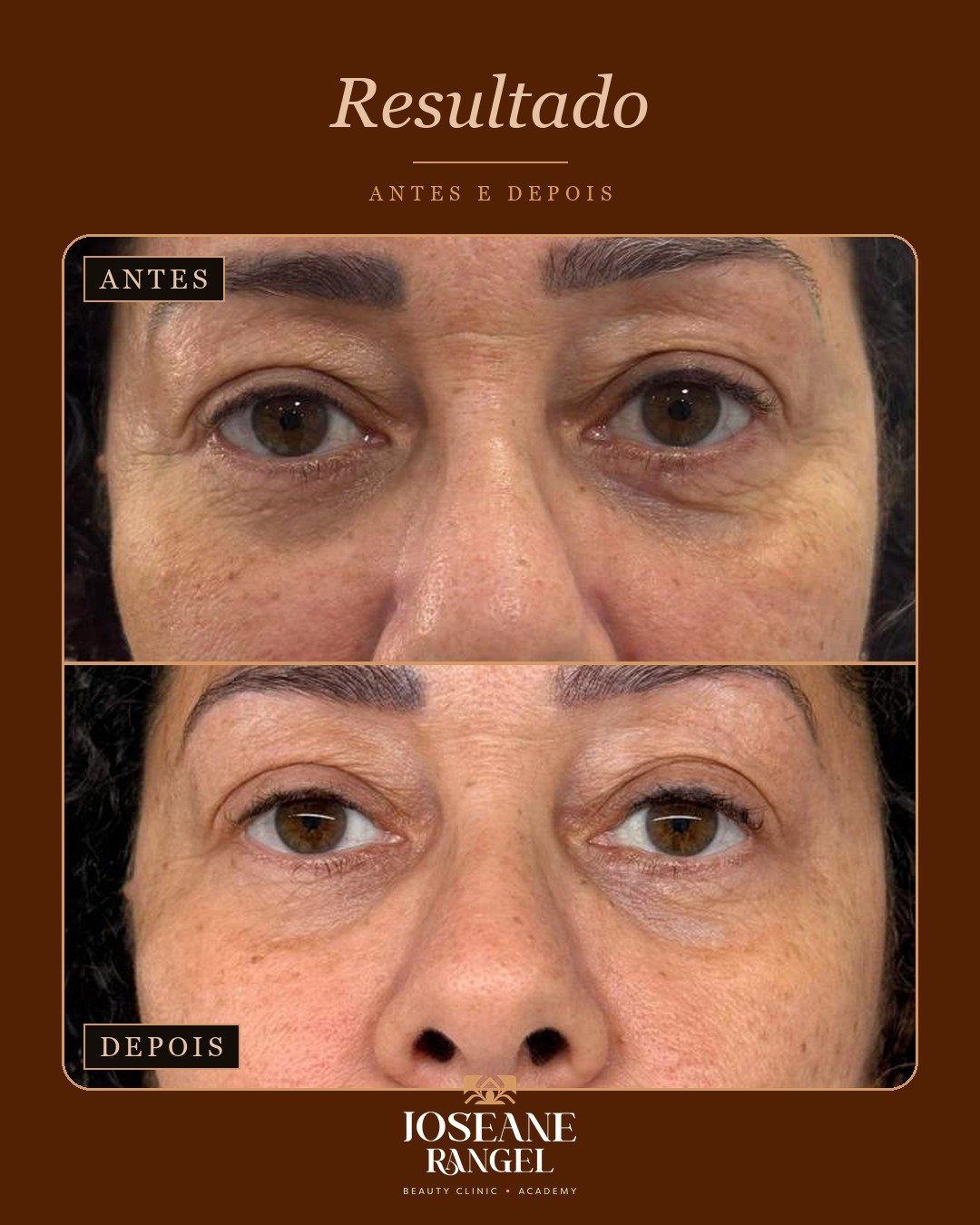 Resultado de micropigmentação de sobrancelhas, antes e depois